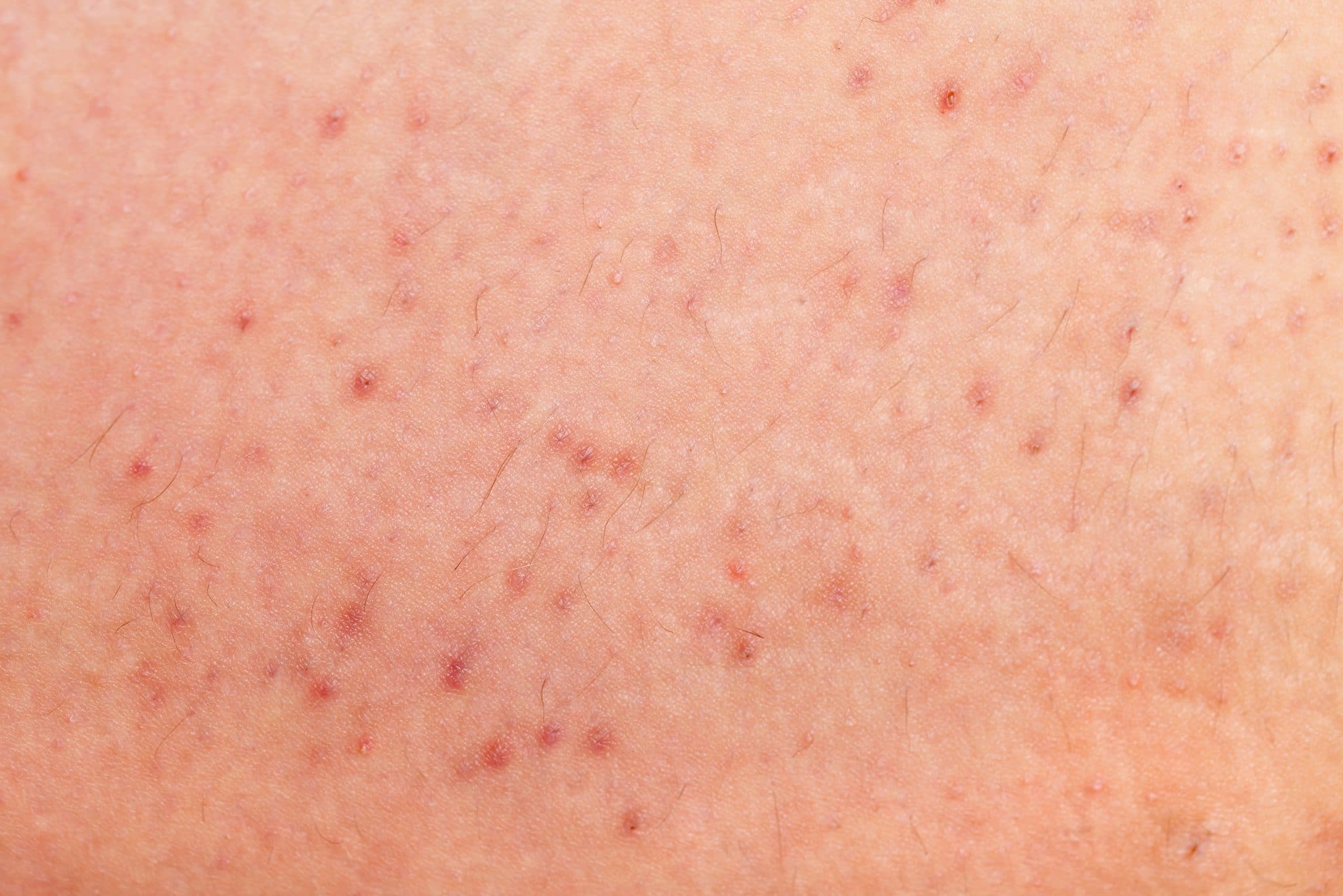 how-to-get-rid-of-razor-bumps-ionia-azur-ag